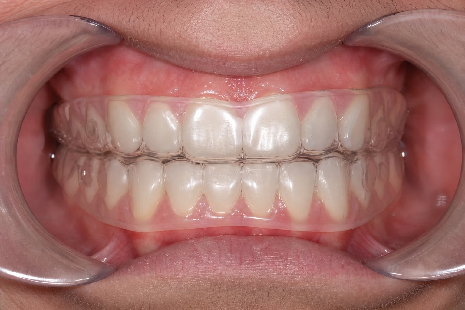 Orthodontic Positioners: Clinical Uses and Lab Production