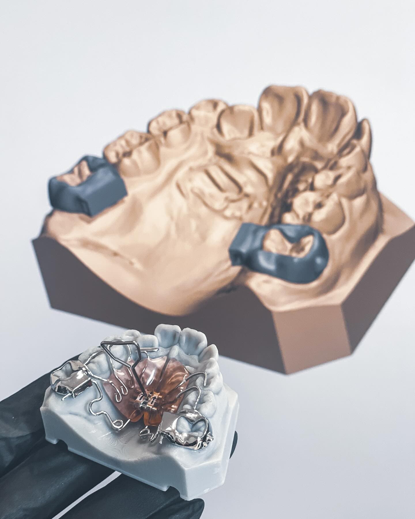 Plaster model compared with 3D printed model showing digital workflow transition