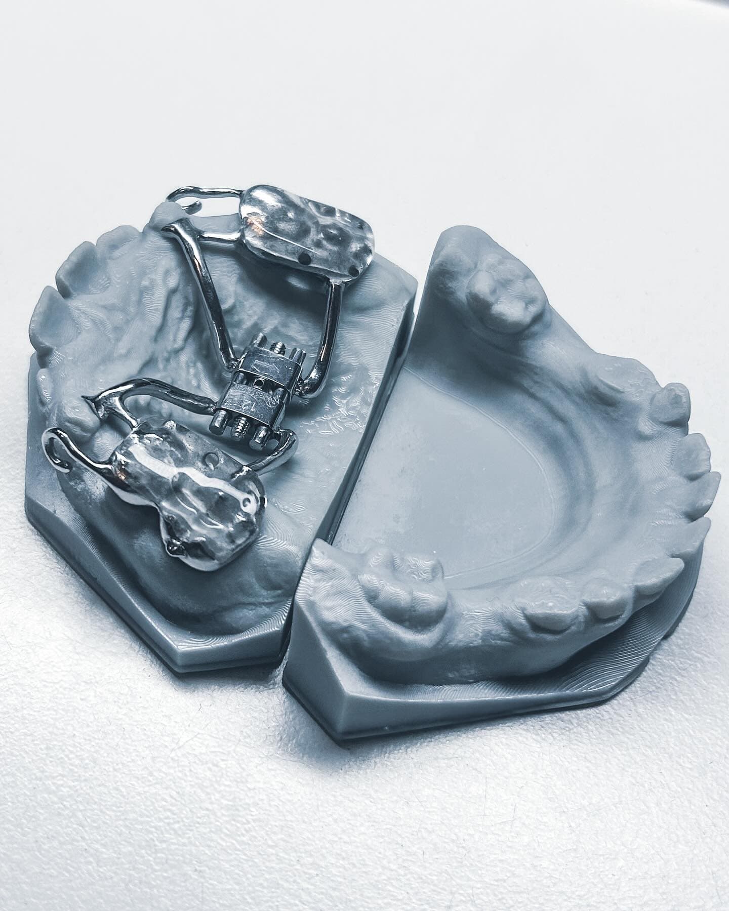 3D printed orthodontic model with precision-fabricated palatal expander by NordicDens