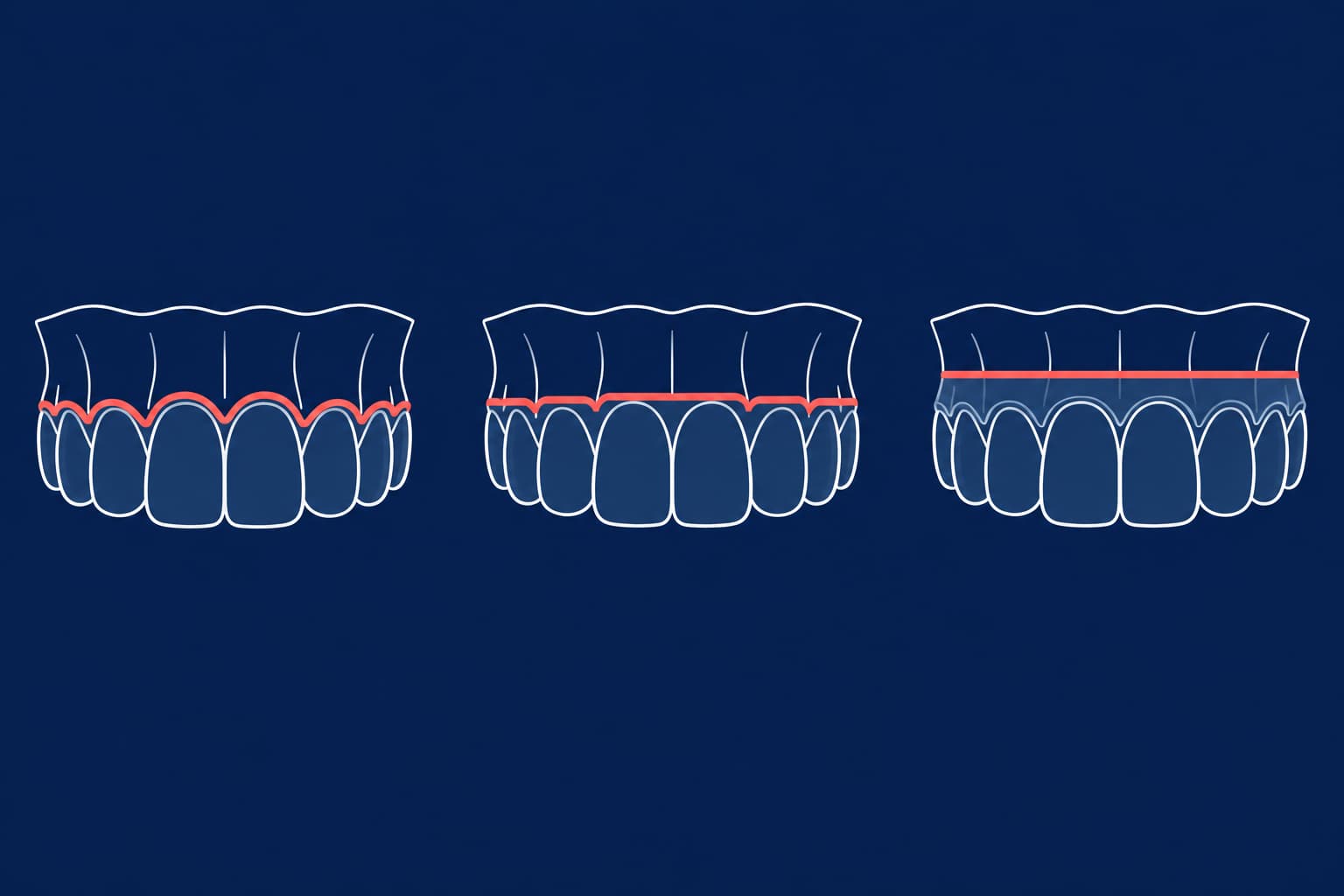 Aligner Trimming Methods: Manual, CNC and Laser Compared