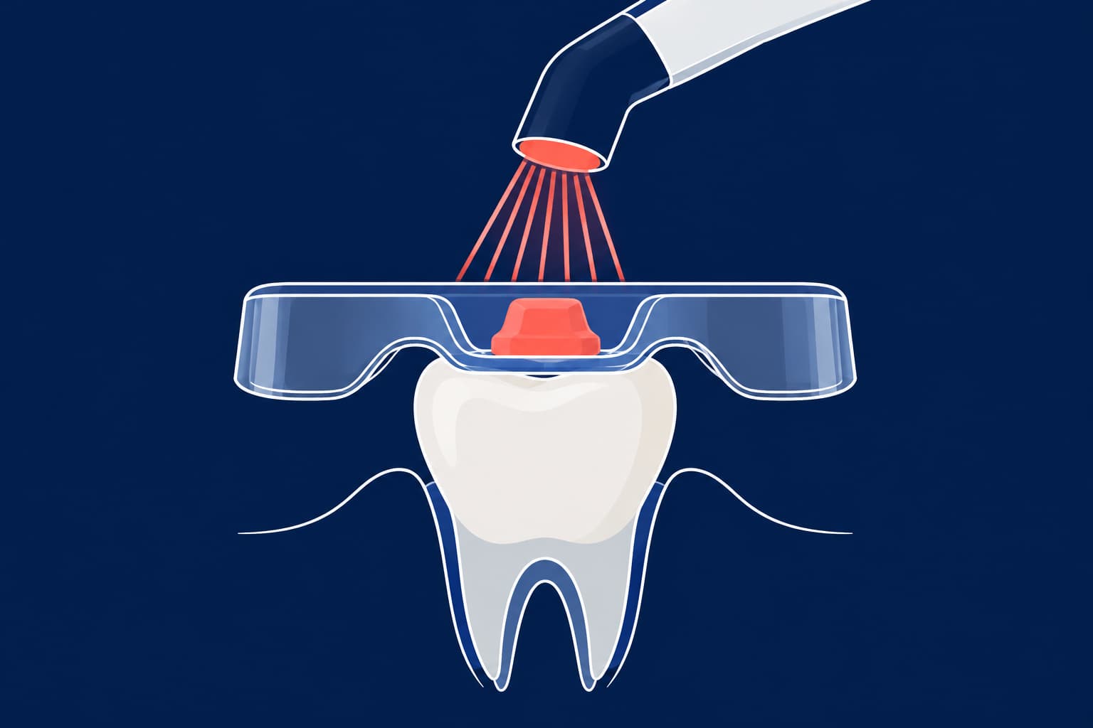 Aligner Attachment Templates: How Labs Make Them Accurate